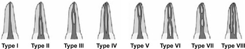 Figure 1 Illustration of the variations in permanent mandibular anterior teeth according to the Vertucci method.Citation1