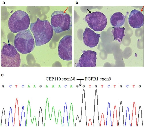 Figure 1. Morphologic changes, FISH analysis and RT-PCR of CEP110-FGFR1 fusion in bone marrow cells at the diagnosis. (a/b) Initial bone marrow showed hypercellular with eosinophilia (black arrow) and monocytosis (red arrow); no deﬁnite blasts were found in this specimen (WrighteGiemsa, 1000). (c) Nucleotide sequence analysis of the PCR product showing CEP110/FGFR1 fusion transcript with a breakpoint at exon 38 of the CEP110 gene and at exon 9 of the FGFR1 gene.