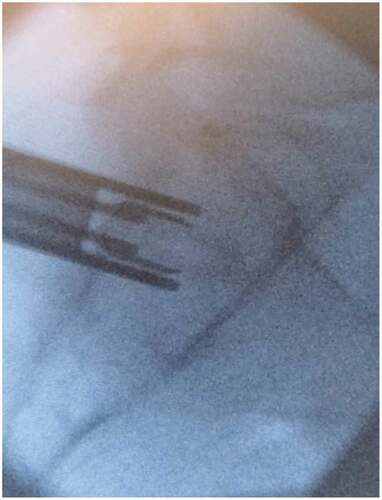 Figure 5. Radiograph of insertion of transfixing bone allograft in the lateral radiographic projection.