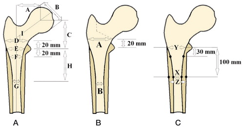 Figure 1. A. Radiological measurements of the proximal femur according to Noble: A, femoral head offset; B, femoral head diameter; C, femoral head position; D, canal width 20 mm above the mid-lesser trochanter line; E, canal width at the mid-lesser trochanter line; F, canal width 20 mm below the mid-lesser trochanter line; G, isthmus diameter; H, isthmus position below the mid-lesser trochanter line; I, neck-shaft angle. B. Radiological canal flare index (CFI) measurements of the proximal femur according to Noble: A, canal width +20 mm above the mid-lesser trochanter line; B, isthmus diameter. CFI = A / B. C. Radiological measurements of the proximal femur: canal-calcar ratio (X / Y) and cortical index ((Z − X) / Z).