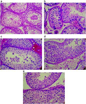 Figure 3.  Seminiferous tubular histology patterns from TESE samples in NOA patients: a) sertoli-cell only syndrom, b) spermatogonial MA, c) spermatocyte MA, d) spermatid MA and, e) hypospermatogenesis. Tissues were stained by haematoxylin.eosin.