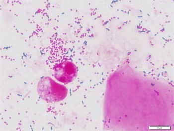 Figure 2 Gram stain of sputum on day of admission.