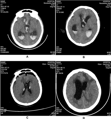 Figure 1 Brain CT after admission in patient with intracranial A.baumannii infection. (A) Before the treatment on July 10, large high-density shadows can be seen on the right frontal lobe and lateral ventricle; (B) After the ventricular drainage on July 11, the right frontal lobe hemorrhage is slightly smaller than before; (C) During the treatment on July 21, ventricular hemorrhage and hydrocephalus was better than before; (D) During the treatment on August 13, bilateral lateral ventricle was dilated, and hydrocephalus progressed more than before.