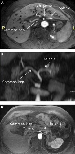 Figure 4 (A) Post-gadolinium magnetic resonance axial images of the abdomen below the level of the celiac artery. The common hepatic (hep.), splenic, and right gastric arteries are identified. (B) Post-gadolinium magnetic resonance coronal maximum intensity projection of the abdomen. The common hepatic and splenic arteries are identified. (C) Post-gadolinium magnetic resonance axial maximum intensity projection of the abdomen. The common hepatic and splenic arteries are identified.