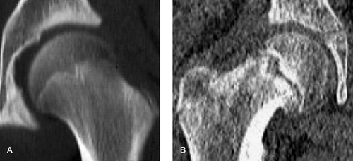 Figure 2. A. An AP CT scanogram of the left hip of a 14-year-old boy showing a well-developed epiphyseal peg. B. A similar CT scanogram of the right hip of a 13-year-old boy who has a poorly defined peg that appears to be showing signs of loosening.