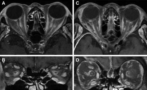 Figure 3 Post contrast axial and coronal T1-weighted magnetic resonance imaging with fat suppression shows perineural enhancement of both optic nerves and orbital fat enhancement in patient 1 (A, B) and patient 3 (C, D).