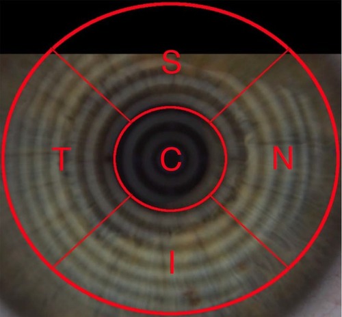 Figure 3 Fixed image of a right lens at one of five time points after blink covered with a lattice structure for grading of individual lens segments (C – central, S – superior, N – nasal, I – inferior and T – temporal).