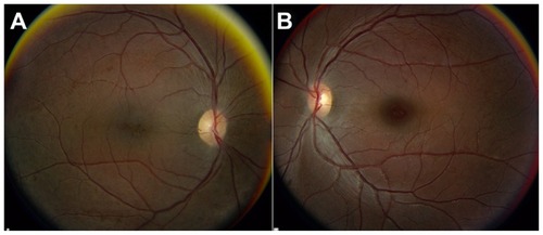 Figure 3 Color fundus photographs of Case 2. The right eye (A) demonstrates a cystic appearance of the fovea. The left eye (B) demonstrates more subtle findings of X-linked retinoschisis.