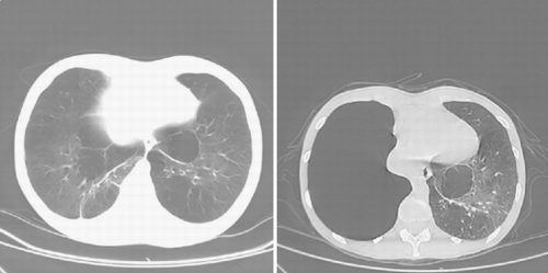 Figure 2. CT scan of the thorax, at presentation (left) and 2 years later (right), again demonstrating the rapid development of a large bulla in the right hemithorax with shift of the heart to the left.