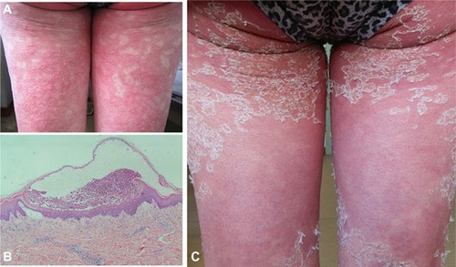 Figure 1 (A) Erythema and hundreds of tiny pustules on the thigh. (B) Skin biopsy revealed formation of subcorneal pustules containing neutrophil aggregates and Kogoj spongiform pustules in the base of the epidermis, and superficial perivascular neutrophil infiltration in the dermis. (C) Mass of scales on the thigh after treatment.