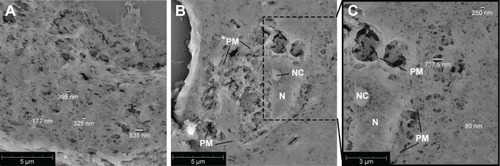 Figure 2 Scanning electron microscopy images of 5 µm cross-sections of 50% Matrigel containing myeloma cells, EPCs and MSCs cultured for 14 days.Notes: (A) Gel meshwork with various pore sizes with the majority <200 nm. The scale bar represents 5 µm. (B) Cross-section of a cell incorporated into the gel. The scale bar represents 5 µm. (C) Zoom of (B), showing more details of the cell and meshwork of the surrounding gel. The scale bar represents 3 µm. Abbreviations: EPCs, endothelial progenitor cells; MSCs, mesenchymal stromal cells; N, nucleus; NC, nucleolus; PM, plasma membrane.