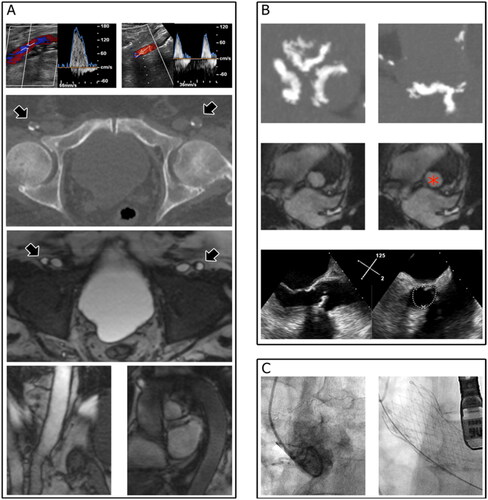 Figure 1. Multimodality imaging for the assessment of TAVI candidates with renal dysfunction. Femoro-iliac-aortic endovascular access (A) was evaluated by duplex scan ultrasound (upper panel showing the left and right femoral arteries), computed tomography (arrowheads in the mid-upper panel indicate the left and right femoral arteries), and nuclear magnetic resonance imaging (arrowheads in the mid-upper panel indicate the left and right femoral arteries). The aortic root and aortic annulus (B) were evaluated using computed tomography (upper panel), nuclear magnetic resonance imaging (red asterisk in the middle panel indicates the aortic annulus region), and echocardiography (lower panel), which were reassessed for confirmation during the procedure (C, left panel). The final shape of the metallic frame of the prosthesis is shown in the right panel of panel C.