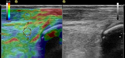 Figure 3 Sonoelastogram (left side of the images) of the Achilles tendon insertion and corresponding B-mode ultrasound images (right side of the images) of the same area. In this ROI, the Kager fat pad was employed for the calculation of fat strain and the SR. B = fat tissue taken into consideration for the calculation of fat strain, A = area of tissue taken into consideration for the calculation of tendon strain.
