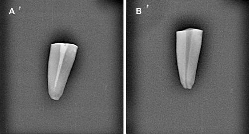 Figure 1 (A) Intracanal medicament placed into the canal after instrumentation and (B) after removal of intracanal medicament.