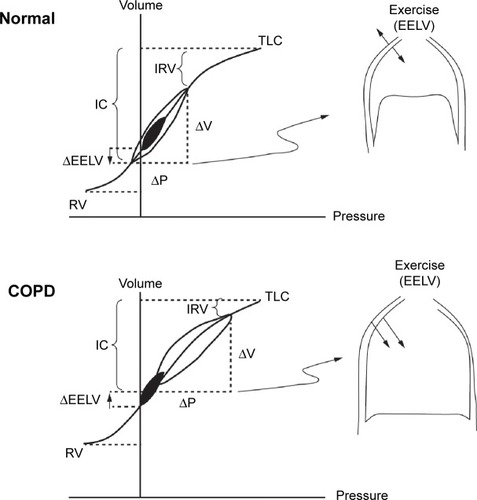 Figure 1 Comparison of pulmonary dynamics in health and COPD showing tidal pressure-volume curves during rest (filled area) and exercise (open area).