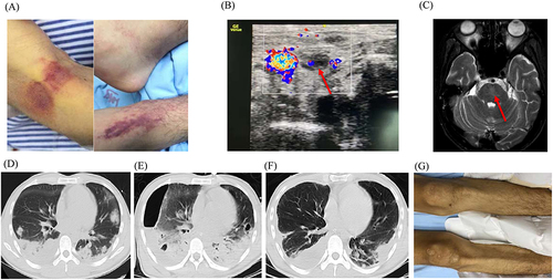 Figure 1 Clinical manifestations of the patient. (A). Day 1, Large purple patches presented on both lower limbs; (B). On day 8, direct bedside ultrasound suggested left intracervical thrombosis (red arrow); (C). MRI revealed patchy abnormal signal foci in the pons, suggesting central pons myelinolysis (red arrow); (D). On day 1, Chest CT showed multiple nodules and mass shadows in both lungs and pleural effusion on both sides; (E). On day 7, CT revealed multiple new cavitary lesions bilaterally, right hydropneumothorax, and left pleural effusion; (F). On day 26, the pulmonary infection was significantly reduced; (G). On day 26, the ecchymosis of lower limbs receded.