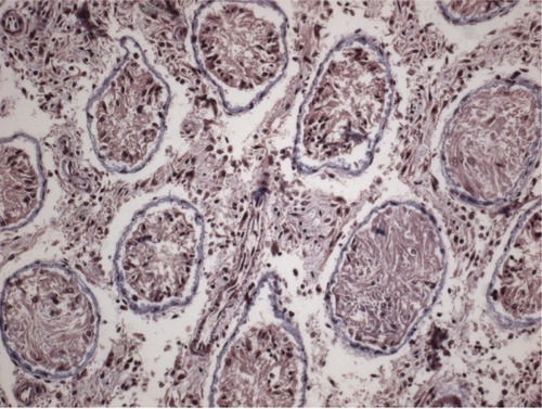 Figure 3 Interstitial fibrosis shown by Masson’s trichrome staining in postpubertal periods.