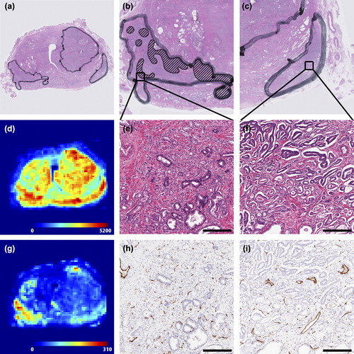Figure 1. Example of histological parameters retrieved from the prostate slices. (a) Overview of H&E stained slice. (b) Detailed image of the right tumour. Gleason grade 4 components are delineated. The rest of the tumour consists of grade 3 components only. (c) Detailed image of the left tumour. This tumour consists only of Gleason grade 3 components. (d) Overview of the distribution of cell densities in the prostate slice (cells/mm2). A large heterogeneity can be appreciated. (e) Detailed zoom of the H&E staining from the right tumour. Gleason grade 3 (lower left) and 4 (upper right) are both present in this image. The whole image has a size of 1 mm2, which is the same as the pixel size in (d). (f) Detailed zoom of H&E staining of the left tumour. A large difference in microscopic structure between image (e) and (f) can be appreciated. (g) Overview of the distribution of microvessel densities in the prostate slice (vessels/mm2). A large heterogeneity can be appreciated. (h) Detailed zoom of the CD31 microvessel staining from the right tumour. This image contains a relatively large number of small vessels (brown staining). (i) Detailed zoom of CD31 staining from the left tumour. A large difference in microscopic structure between image (h) and (i) can be appreciated. More large vessels are shown in (i) compared to (h). Scale bars: 250 μm.
