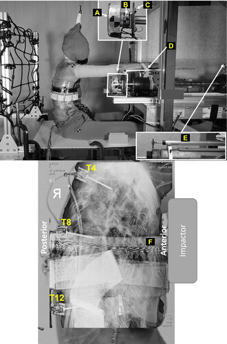 Figure 1. Overall experimental setup (top) and lateral X-ray (bottom) showing instrumentation on an exemplar PMHS. A: a circular impactor (diameter = 15.2 cm); B: six-axis loadcell; C: accelerometer; D: armrest; E: displacement potentiometer; F: chestband.