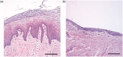 Figure 2. Hematoxylin–eosin stained biopsies from the vaginal wall in healthy women with thick squamous cell epithelia with dermal papillae (A), and cervical cancer survivors with thin epithelia and dense connective tissue (B). Scale bar =200 μm.