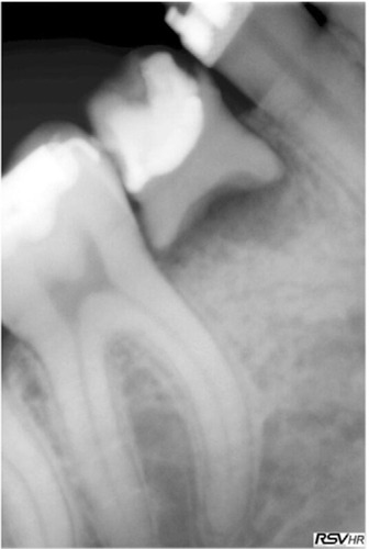 Figure 3 The unrestorable carious and exfoliating mandibular second deciduous molar.