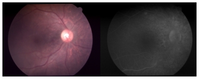 Figure 2 A) Color photograph of eye fundus after systemic steroid therapy B) fluorescein angiography – late phase – vasculitis evolving to salt and pepper lesion.