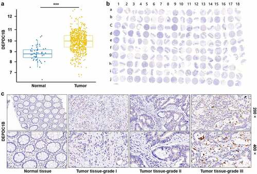 Figure 1. DEPDC1B is highly expressed in CRC. (a) The expression profile of DEPDC1B was analyzed based on 635 tumor and 51 normal samples in The Cancer Genome Atlas (TCGA) database. (b) 99 CRC samples and 81 adjacent normal tissues constituted a tissue microarray (TMA). The whole scanned image of the TMA by IHC of DEPDC1B in CRC and compared normal colorectal tissue. Scale bar, 1 mm. The odd column corresponds to the tumor tissue, and the even column corresponds to the normal tissue adjacent to the cancer. The row of letter J and I15–18 correspond to tumor tissue. (c) Representative images of IHC staining of DEPDC1B in normal tissue and tumor tissue of CRC patients.