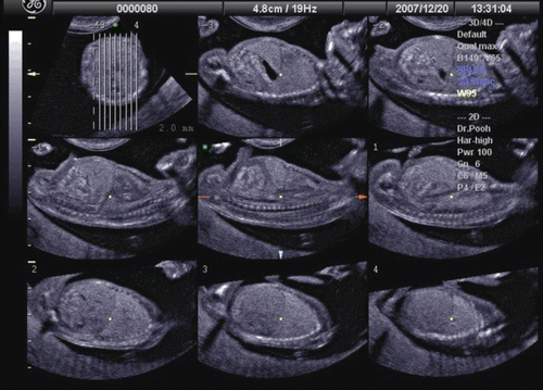 Figure 17.  Tomographic ultrasound imaging of normal thoracoabdominal structure at 13 weeks of gestation. Parallel sagittal sections are shown. Lung-liver border and intraabdominal organs are clearly visualized.