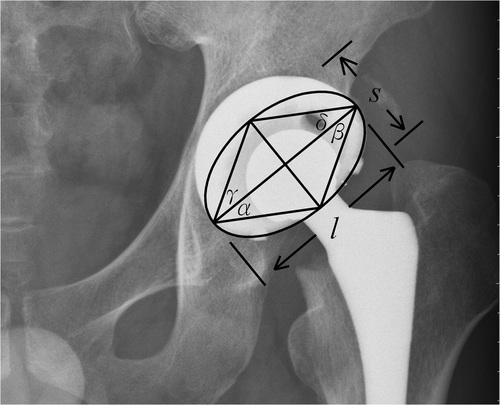 Figure 1. Post-operative radiograph of total hip arthroplasty with a U2 Total Hip Joint (United Orthopedic Corporation, Hsinchu, Taiwan). We marked the outer shell of the acetabulum with an ellipse (s = the short axis of the ellipse; l = the long axis). Wan et al. described the measured angle α as acetabular radiographic version Citation[15]. Because of the symmetry of the ellipse, angle α is equal to angles β, γ, and δ. We previously used a special protractor to measure angle β for acetabular radiographic version Citation[7].