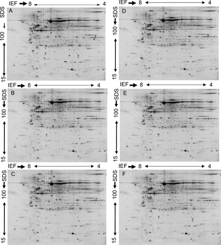 Figure 1 Representative 2-DE gel images of protein profiles of invasive breast carcinoma.
