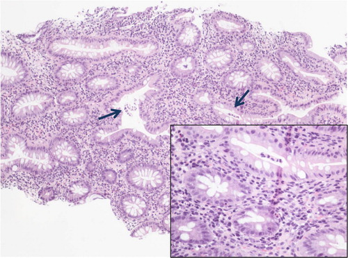 Fig. 4 Colon biopsy showing crypt distortion and increased chronic inflammation within the lamina propria. Arrows denote two small crypt abscesses (inset: small crypt abscess and mixed inflammatory infiltrate within the lamina propria including neutrophils).