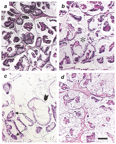 Figure 9. Histological analysis of a patient-derived colon tumor pre-treated with FR-WBH followed by DOXIL treatment. (A) A tumor section from a non-treated SCID mouse bearing a patient-derived colon carcinoma (9934-5P) showing the acinar histology that is typical of a colon adenocarcinoma. (B) Section from a tumor in an animal treated with FR-WBH alone revealing some changes in the organization in the tumor; the stroma (*) space appears to occupy a greater volume with occasional blood vessels becoming more visible. (C) Section from a tumor in an animal treated with DOXIL alone. In some areas, the tumor structure appears normal (arrow) and in other areas, the tumor cells are largely destroyed by the DOXIL treatment (arrowhead). (D) Section from a tumor in an animal pre-treated with FR-WBH followed by DOXIL treatment showing significant destruction of tumor cells throughout the section and revealing a greater volume of the interstitial space and stromal elements. Each figure was prepared from the patient- derived tumors collected on Day 25 in the experiment shown in Figure 8B. Bar equals 100 um.