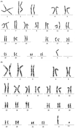 Figure 2. G-band chromosomal analysis of peripheral blood lymphocytes revealed 45,X/46,X,+mar and 45,X. (A) G-band chromosomal analysis of peripheral blood lymphocytes revealed 45,X/46,X,+mar. A GTL banded karyotype of the patient showing an 45,X cell line. All autosomes appear normal in their banding patterns. (B) G-band chromosomal analysis of peripheral blood lymphocytes revealed 45,X. A GTL banded karyotype of the patient showing an 46,X,+marker. All autosomes appear normal in their banding patterns.
