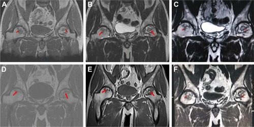 Figure 1 MRI images show the differences of femoral hip cystic lesions pre- and post-treatment from a 47-year-old male patient with bilateral femoral hip cystic lesions.Notes: A: pre-treatment; B: 1 year after treatment; C: 3 years after treatment; D: 6 years after treatment; E: 9 years after treatment and F: 12 years after treatment. Red arrows point out the cystic lesions.