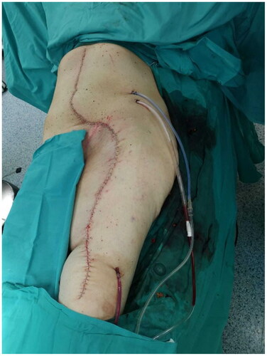 Figure 2. Photograph of the surgical site at the end of the surgery.