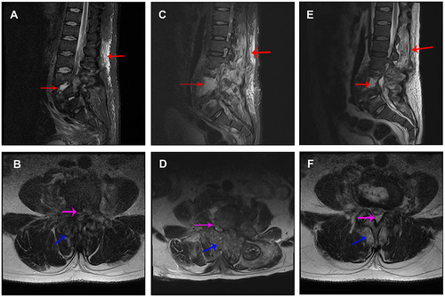 Figure 2 Fat-suppressed T2-weighted MRI images at different time-points. (A) Sagittal MRI image at admission; (B) axial MRI image of L4–5 disc space at admission; (C) sagittal MRI image at 78 days after admission; (D) axial MRI image of L4–5 disc space at 78 days after admission; (E) sagittal MRI image at re-examination; (F) axial MRI image of L4–5 disc space at re-examination. Red arrows indicate hyperintense signal in vertebral bodies and paravertebral tissue. Pink arrow indicates spinal canal abscess. Blue arrow indicates paravertebral soft tissue abscess. The damaged area was extended at 78 days after admission but relieved at re-examination.