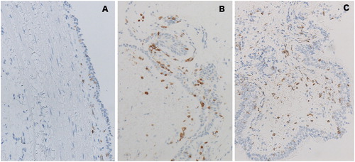 Figure 4. Typical bronchial biopsy specimens from a control subject (A), a patient with CTRB (B), and a patient with CTRAEB (C) stained with anti-CD3 antibody. The specimen from the patient with chest tightness contained many CD3-positive cells.