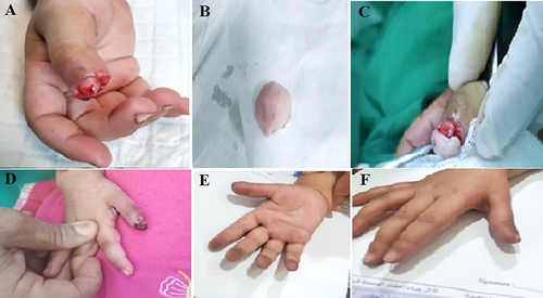 Figure 2 Thumb fingertip amputation beyond the Distal interphalangeal joint (A). Amputated tip (B). Reattached the fingertip (C). Postoperative appearance (D). 5th-week postoperative appearance [Palmar view (E) and Dorsal view (F)].