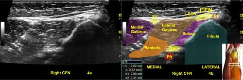 Figure 4 An abnormal right common fibular nerve (CFN) with twice the normal CSA (22 mm2) at the fibular head (A, B) of the same patient in Figure 3.Citation24,Citation25 4a is the original ultrasound image. The (B) shows the CSA of the abnormal right CFN and the color shadings with labels for sonoanatomy, Image is courtesy of 3D4Medical’s Essential Anatomy 5 app.Abbreviations: BF, biceps femoris; Gastroc, gastrocnemius; LSCN, lateral sural cutaneous nerve; PA, popliteal artery; SN, sural nerve; TN, tibial nerve.