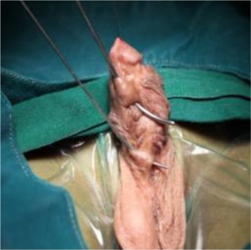 Figure 2 Multiple urethrocutaneous fistula.