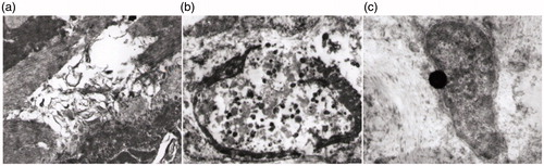 Figure 1. The ultra-structure changes of a fibroid cell immediately after RF ablation. (a) In the centre of the ablated lesion the fibroid cell had muscle contraction, dissolution, fracture and nuclear content outflows. (b) At the edge of the ablated lesion the vascular endothelial cell had proliferated, thrombosis had formed within the lumen, the interstitial vascular was occluded and inflammatory cells had infiltrated. (c) At 1 cm away from the center of the ablated lesion, the fibroid tissue had slightly vacuolated mitochondria, a normal nucleus and chromosomes, and inflammatory cell infiltration.