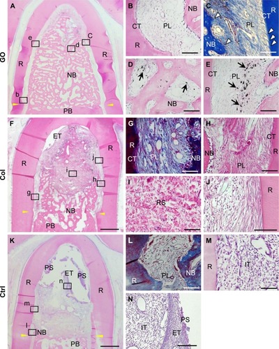 Figure 5 Histological findings after implantation of GO scaffold into dog class II furcation defects.Notes: (A–E) GO scaffold. High magnification (B–E) of the framed areas (b–e) in (A). Periodontal ligament-like tissue, cementum-like tissue, and alveolar bone with the insertion of Sharpey’s fibers (white arrowheads) was demonstrated. Black spots (black arrows) were found in the newly formed bone marrow and periodontal ligament-like tissue. (F–J) Collagen scaffold. High magnification (G–J) of the framed areas (g–j) in (F). (K–N) No implantation. High magnification (L–N) of the framed areas (l–n) in (K). Staining with H&E (A, B, D–F, H–K, M, N) and Masson’s trichrome (C, G, L). Scale bars represent 1 mm (A, F, K) and 100 μm (B–E, G–J, L–N). Yellow arrowheads (A, F, K) indicate the apical bottom of the periodontal defect.Abbreviations: Col, collagen; CT, cementum-like tissue; Ctrl, control; ET, epithelial tissue; GO, graphene oxide; IT, inflammatory tissue; NB, new bone; PB, preexisting bone; PL, periodontal ligament-like tissue; PS, plaque-like structure; R, root; RS, residual scaffold.