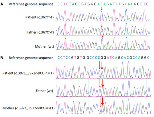 Figure 4 Fanconi anemia complementation group A gene sequence diagram of the patient. (A) c.367C>T was detected in the patient and his father. (B) c.3971_3972delCGinsTT was detected in the patient and his mother. Variants were indicated with arrows; wt, wild type.