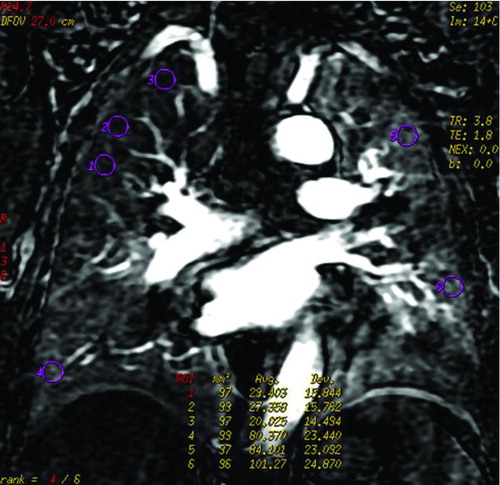 Figure 1.  An example of ROIs and signal intensity-time course curves (Figure 1a) Coronal perfusion image of the pulmonary parenchyma acquired with DCE-MRI was heterogeneous. ROI 1, 2 and 3 represented perfusion defects, and ROI 4, 5 and 6 represented normal lung perfusion. (Figure 1b) Signal intensity-time curves of these ROIs showed maximum signal intensity of the perfusion defects were lower than that of normal lung.