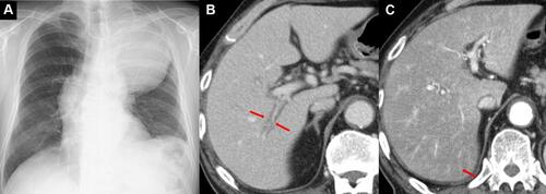 Figure 1 Chest X ray, enhanced abdominal CT on the admission. (A) Chest X ray showing a mass shadow in the left upper lung field. (B) Enhanced abdominal CT showing periportal collar signs. (C) Enhanced abdominal CT showing a heterogeneous contrast effect on the liver in the early contrast phase.
