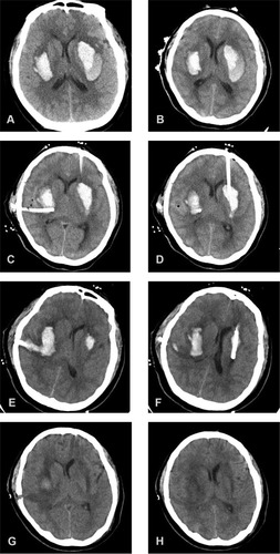 Figure 1 Non-contrast head CT showing bilateral basal ganglia hemorrhages. (A) Hemorrhage volume was about 18 mL on the right and 27 mL on the left side. (B) Markers applied to the patient’s head before MIS to indicate puncture points and allow tracking. Hemorrhage volume was about 19 mL on the right and 29 mL on the left side. (C, D) Immediate postoperative head CT scan showing a reduced hematoma volume. Hemorrhage volume was about 14 mL on the right and 11 mL on the left side. (E, F) Postoperative day 3 CT scan showing residual clots (10 mL on the right and 2 mL on the left side). (G, H) Postoperative day 19 CT scan showing that the intracranial hematoma was absorbed.