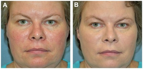 Figure 3 Patient with (A) noticeable erythema and telangiectasias on the cheeks due to rosacea, and (B) immediate improvement without irritation after makeup application prior to initiation of pulsed dye laser therapy.