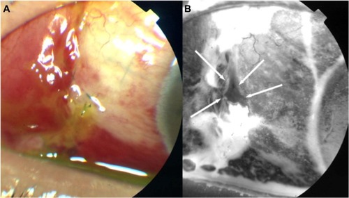 Figure 1 Apparent point leakage with severe ocular surface failure.