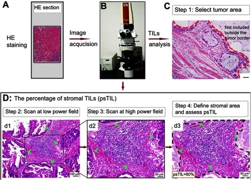 Figure 1 The flowchart of study design and stromal TILs evaluation.Notes: (A) Routine H&E staining method was adopted to assess TILs. (B) An Olympus BX51 fluorescence microscope was used for image acquisition at ×100 and ×200 magnification, respectively. Then, TILs were visually estimated on the morphological characteristics following a standardized methodology. (C) TILs should be assessed within the tumor borders of the invasive tumor. (D) Stromal TILs were defined and assessed according to steps shown from d1 (×100) to d2 and d3 (×200). In the image field, tumor cells should be present at all borders, which was indicated by green arrowheads. On this basis, different TILs areas should be evaluated at higher magnification (×200 in this study).Abbreviation: TILs, tumor-infiltrating lymphocytes.