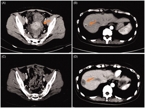 Figure 3. A 48-year-old woman with solitary ovarian cancer liver metastasis (OCLM). (A) Contrast-enhanced CT shows ovarian cancer (OC) lesions (arrow) located on ovary in the arterial phase; (B) Contrast-enhanced CT shows OCLM lesion (*, arrow) located on S7 in liver; (C) Contrast-enhanced CT shows OC lesions removed by cytoreductive surgery (CRS) after 3 months (arrow); (D) Contrast-enhanced CT shows OCLM lesion (*, arrow) underwent microwave ablation (MWA) after 2 months.